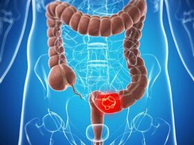 Surge of Colorectal Cancer in US | Credits: Google Images