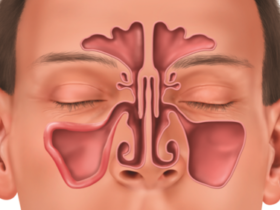 Chronic sinusitis situation is considered an all-too-common affliction by the experts