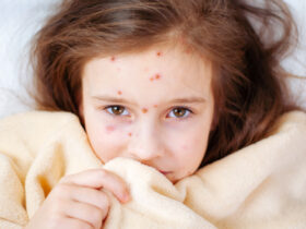 Measles Outbreak in Florida Elementary School