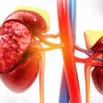 Neglected Kidney Disease Emerges