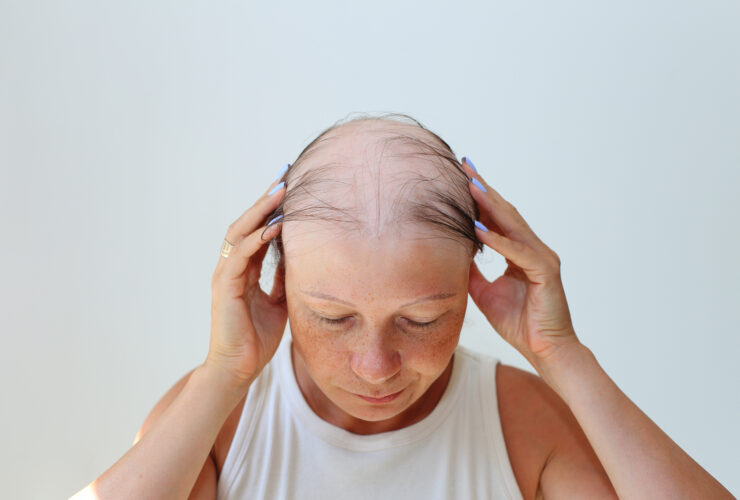 Hope for Hair Regrowth in Alopecia Areata Patients